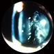Amyloidosis of the Vitreous Amyloidosis of the Vitreous