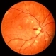 Malignant Hypertension Malignant Hypertension