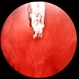 Foreign Body in Retina Foreign Body in Retina