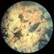 Toxic Retinopathy