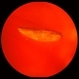 Intraocular Foreign Body Intraocular Foreign Body