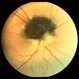 Melanocytoma Melanocytoma