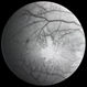 Macular Ischemia