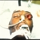Auto-Enucleation with Tire Iron Auto-Enucleation with Tire Iron