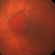 Hemangioma