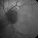 Hemangioma-redfree
