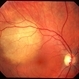 Choroidal metastasis - case 4 Choroidal metastasis - case 4