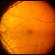 Solar maculopathy 1 Solar maculopathy 1