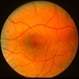 Solar maculopathy 2 Solar maculopathy 2