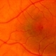 Solar maculopathy 3 Solar maculopathy 3