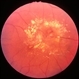 Retinal arterial macroaneurysm with exudation Retinal arterial macroaneurysm with exudation