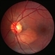 Choroidal osteoma case 1 no 1 Choroidal osteoma case 1 no 1