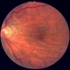 Choroidal folds due to hypotony Choroidal folds due to hypotony