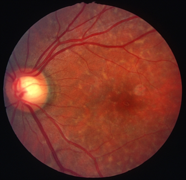 Stargardt disease case 2 image 2 - Retina Image Bank