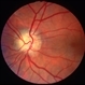 Optic disc drusen, left eye - L stereo Optic disc drusen, left eye - L stereo