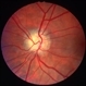 Optic disc drusen, left eye - R stereo Optic disc drusen, left eye - R stereo