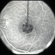 Adult vitelliform dystrophy case 2 - FA Adult vitelliform dystrophy case 2 - FA
