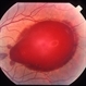 Valsalva retinopathy 1 Valsalva retinopathy 1