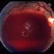 Valsalva retinopathy 2 Valsalva retinopathy 2