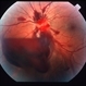 Valsalva retinopathy 3 Valsalva retinopathy 3