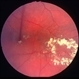 Macular aneurysmal telangiectasia Macular aneurysmal telangiectasia