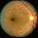 Welding arc maculopathy right eye Welding arc maculopathy right eye
