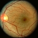 Welding arc maculopathy left eye Welding arc maculopathy left eye