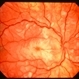Purtscher retinopathy 2 right eye Purtscher retinopathy 2 right eye