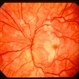 Purtscher retinopathy 2 left eye Purtscher retinopathy 2 left eye