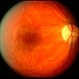 Hypertensive optic neuropathy and choroidopathy right eye Hypertensive optic neuropathy and choroidopathy right eye