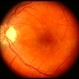 Hypertensive optic neuropathy and choroidopathy left eye Hypertensive optic neuropathy and choroidopathy left eye