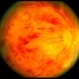 CRVO ischemic - color image CRVO ischemic - color image