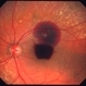 Ruptured retinal arterial macroaneurysm Ruptured retinal arterial macroaneurysm