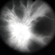 CRVO ischemic - FA 3 CRVO ischemic - FA 3