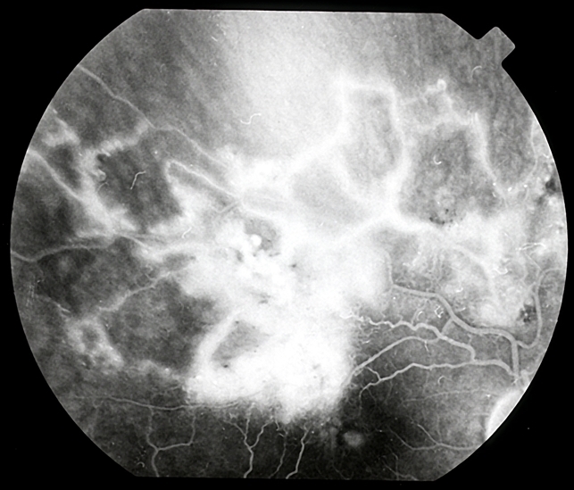 brvo with cme icd 10