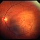 Choroidal metastasis case 1 Choroidal metastasis case 1
