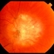 Combined hamartoma - color image Combined hamartoma - color image
