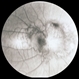 Combined hamartoma - FA 1 Combined hamartoma - FA 1