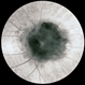 Combined hamartoma - FA 2 Combined hamartoma - FA 2