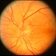 Papilloedema left eye