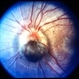 Optic nerve melanocytoma case 3 - color Optic nerve melanocytoma case 3 - color