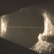 Optic nerve melanocytoma case 3 - Bscan Optic nerve melanocytoma case 3 - Bscan