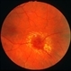 Retinal arterial macroaneurysm Retinal arterial macroaneurysm