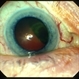 Ciliochoroidal melanoma case 2 Ciliochoroidal melanoma case 2
