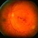 Diabetic ischaemic maculopathy - color Diabetic ischaemic maculopathy - color