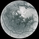Diabetic ischaemic maculopathy - FA Diabetic ischaemic maculopathy - FA