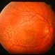 Cuticular (basal laminar) drusen - colour RE Cuticular (basal laminar) drusen - colour RE