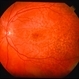 Cuticular (basal laminar) drusen - colour LE Cuticular (basal laminar) drusen - colour LE