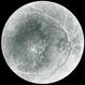 Cuticular (basal laminar) drusen - FA 1 Cuticular (basal laminar) drusen - FA 1