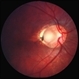Optic disc pit 2 Optic disc pit 2